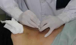 小针刀治疗视频,视频教学深度解读